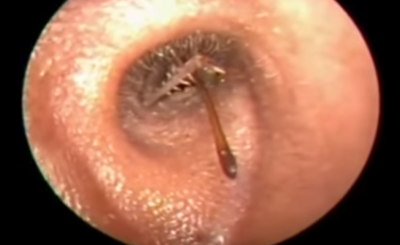 HUGE bug in kid’s Ear! Gross! VIDEO