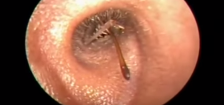 HUGE bug in kid's Ear! Gross! VIDEO
