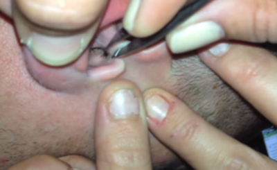 Bug Buried in Guy’s Ear - Moth and Tick in Man's ear