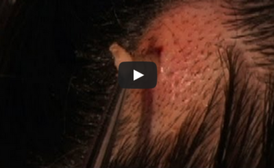 World's Weirdest - Larva Removed from a Girl's Scalp